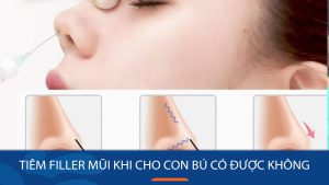 Tiêm filler mũi khi cho con bú có được không? Những điều cần lưu ý