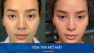 Tiêm tan mỡ mặt là gì? – có hiệu quả không, giá bao nhiêu