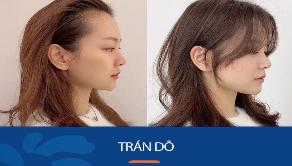 Giải Mã Tướng Trán Dô: Hé Lộ Bí Ẩn [Vận Mệnh/Sức Khỏe/Tình Duyên] Cho Người Sở Hữu