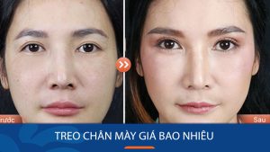 Treo chân mày giá bao nhiêu? Bảng giá cập nhật mới nhất 2024