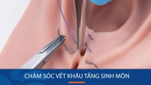 Vết khâu tầng sinh môn bị hở: Giải đáp thắc mắc và cách xử lý hiệu quả