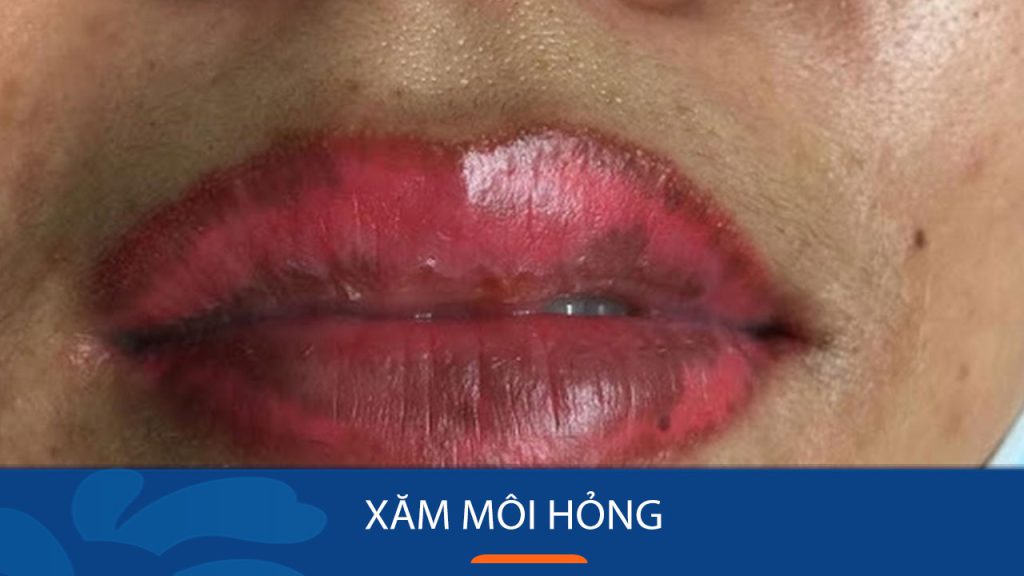 Các dấu hiệu xăm môi hỏng? cách khắc phục cho môi mau lành