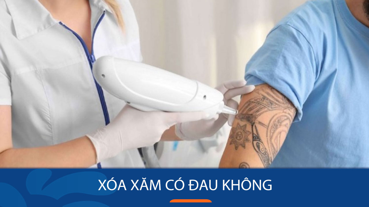 Xóa hình xăm tổ hợp công nghệ PICO sạch mực, không sẹo