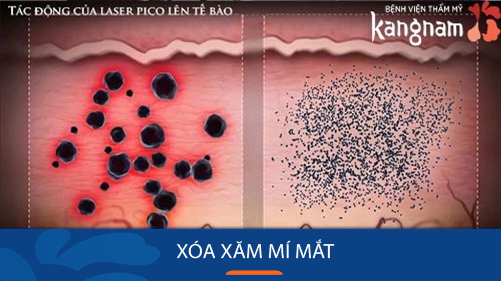 Trường hợp nào cần phải xóa xăm mí mắt? cách xóa xăm mí mắt