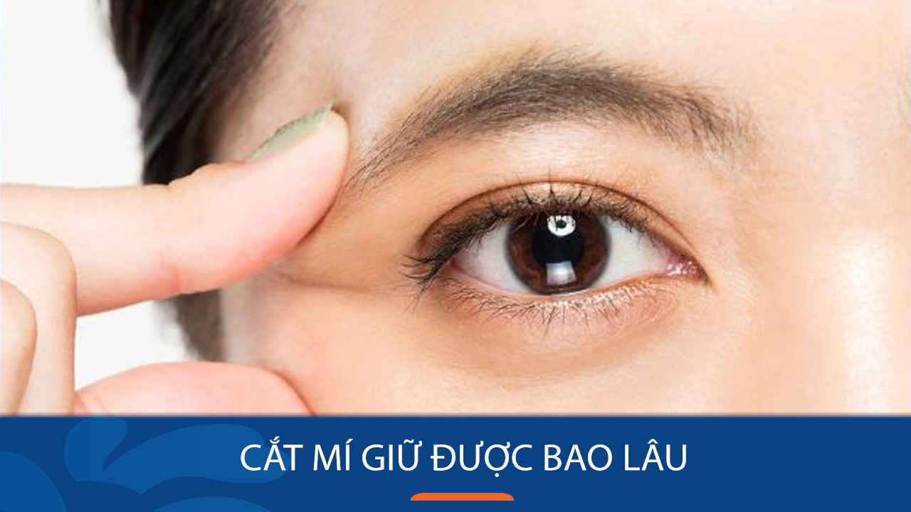 Cắt mí giữ được bao lâu? những yếu tố ảnh hưởng