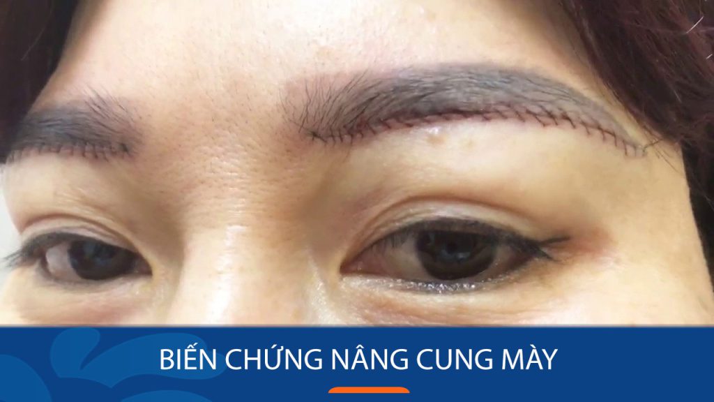 Cảnh báo: Biến chứng kinh hoàng sau nâng cung mày mà ai cũng nên biết