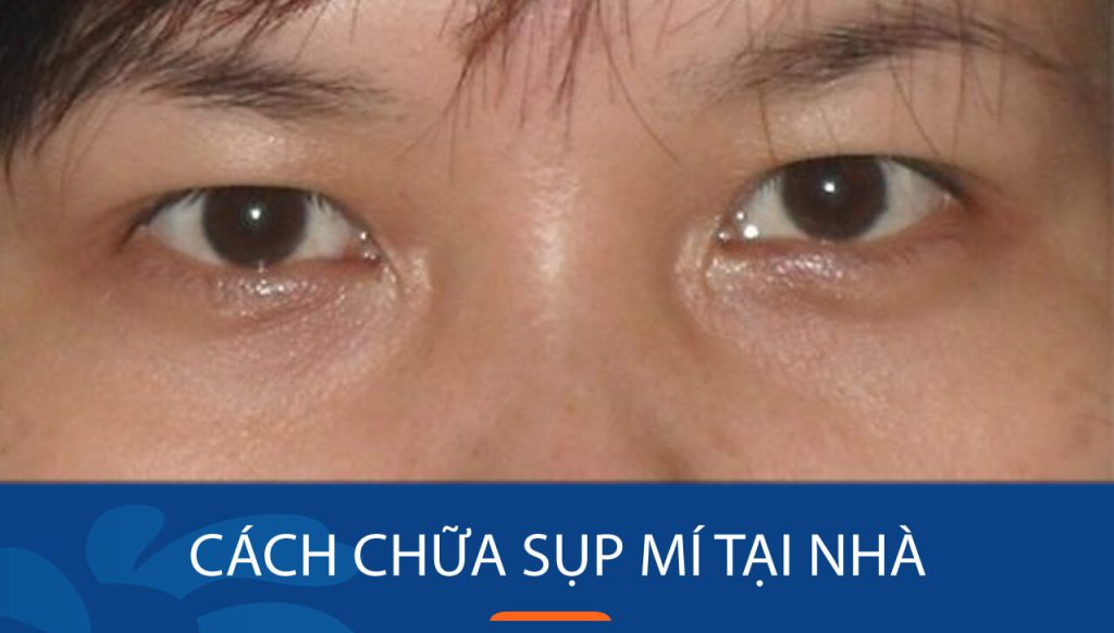 7 Cách chữa sụp mí hiệu quả tại nhà – Bí quyết lấy lại đôi mắt to tròn [Có hình ảnh minh họa]