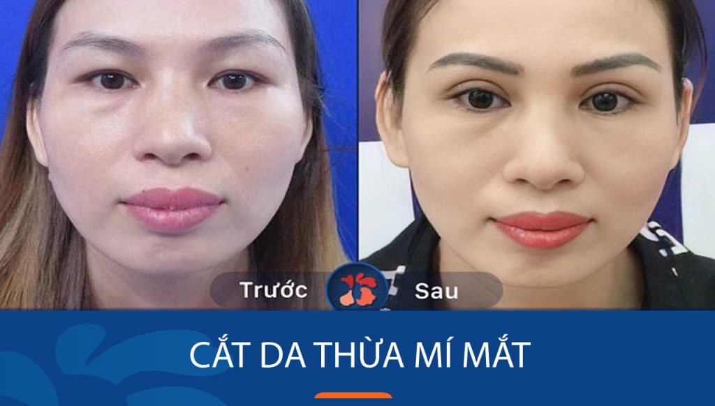 Cắt da thừa mí mắt- Lấy lại đôi mắt trẻ trung, rạng rỡ