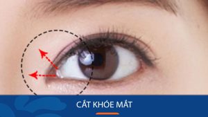 Mở rộng góc mắt – tạo mắt to tròn- chỉ sau 40 phút tại Kangnam