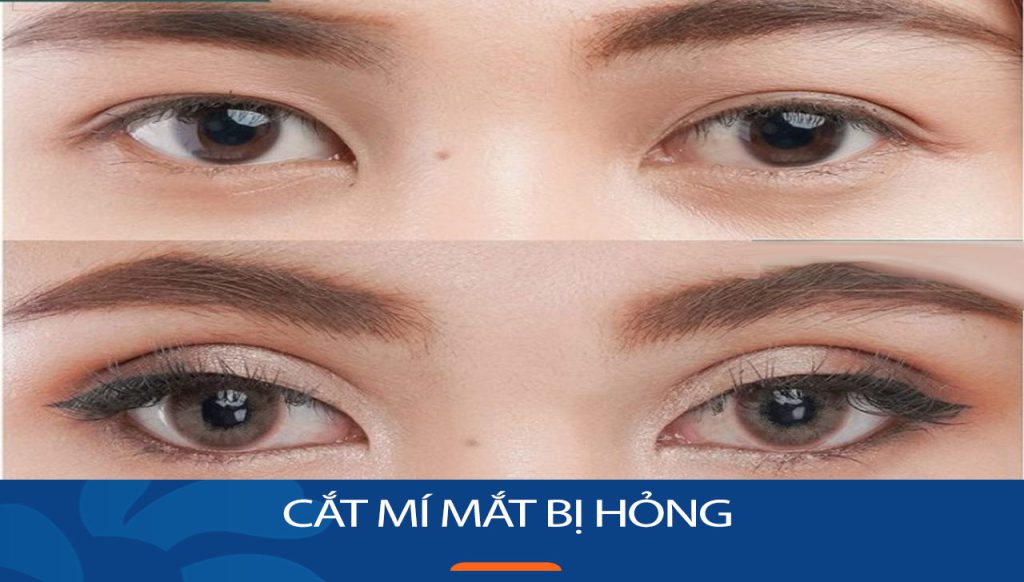 Vì sao cắt mí hỏng? một số hình ảnh rõ nét