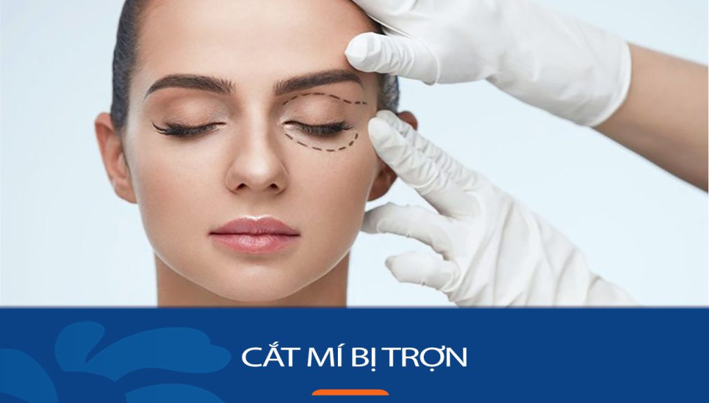 Cắt mí bị trợn là gì? có nguy hiểm không