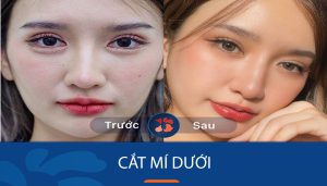 Cắt mí mắt dưới: Giải pháp đánh thức vẻ trẻ trung của bạn