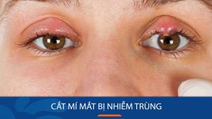 Cắt mí mắt bị nhiễm trùng: Chăm sóc giúp vết thương nhanh lành