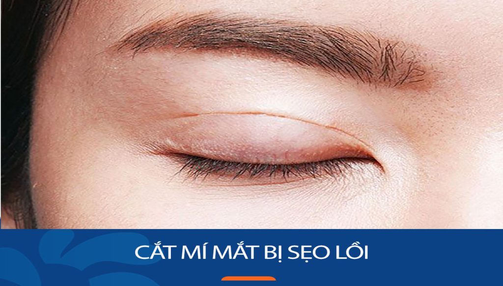Cắt mí mắt có bị sẹo lồi không? Giải đáp từ chuyên gia
