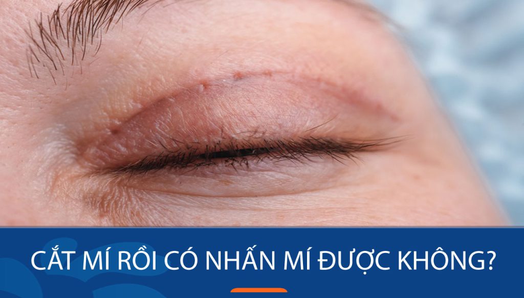 Cắt mí rồi có nhấn mí được không – sự lựa chọn phù hợp cho bạn