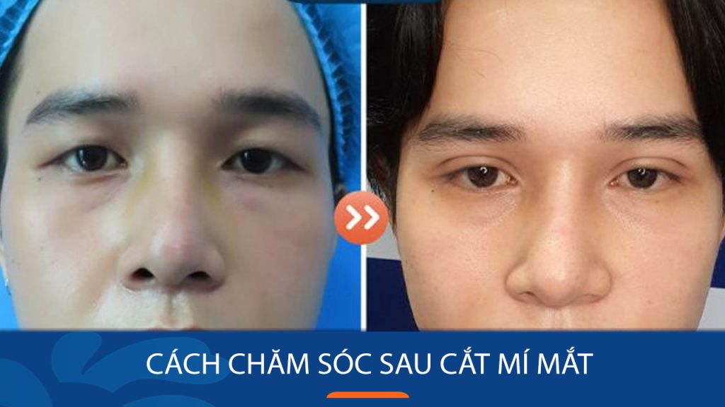 Cắt mí sau 15 ngày: Sự thay đổi khiến bạn bất ngờ
