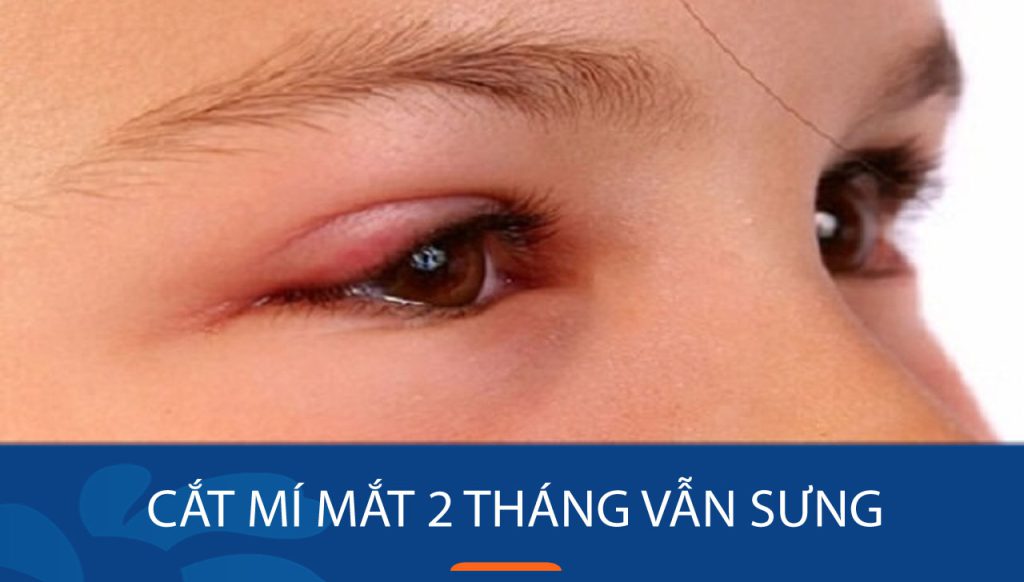 Cắt mí 2 tháng vẫn sưng ? Một số nguyên nhân chính