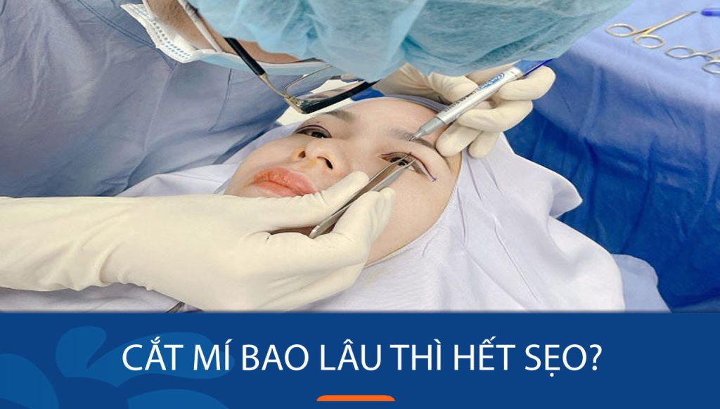 Cắt mí bao lâu thì hết sẹo? một số lưu ý khi quan trọng