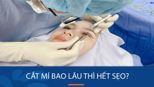 Cắt mí bao lâu thì hết sẹo? Những yếu tố quan trọng