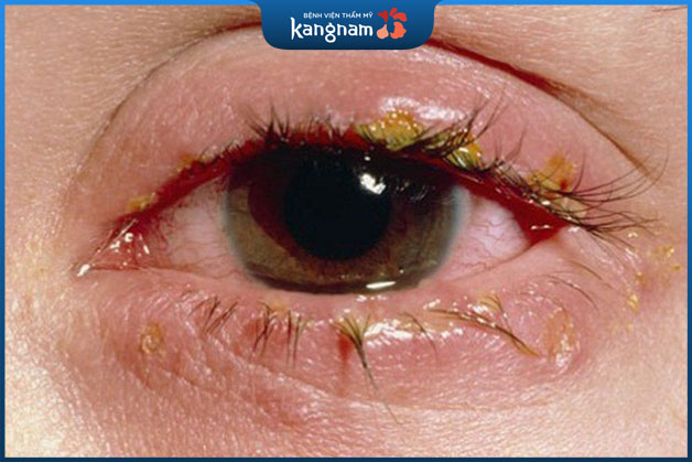 Những mầm bệnh sẽ xuất hiện trong thời gian dài chảy nước mắt khiến mắt bị nhiễm trùng 