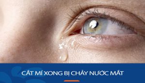 Cắt mí xong bị chảy nước mắt: Cách khắc phục triệt để