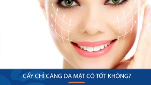 Cấy chỉ căng da mặt: Thời gian duy trì hiệu quả và những lưu ý cần biết