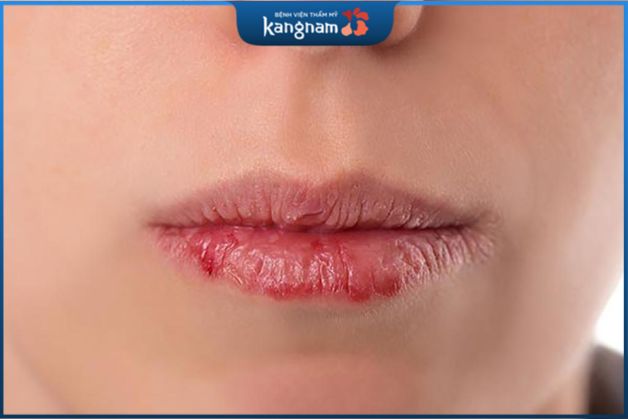 Bệnh chàm môi có thể xuất hiện ở bà bầu đang trong quá trình mang thai