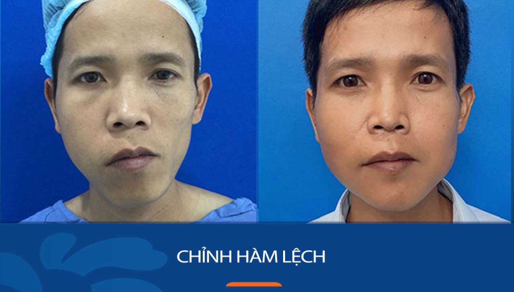 Chỉnh hàm lệch: 90% bệnh nhân hài lòng về kết quả chỉnh hàm