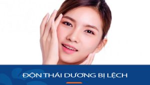 Độn Thái Dương bị lệch: Nguyên nhân, triệu chứng và cách điều trị hiệu quả