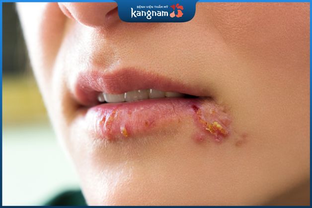 Herpes môi gây đau rát và ngứa, sưng đỏ