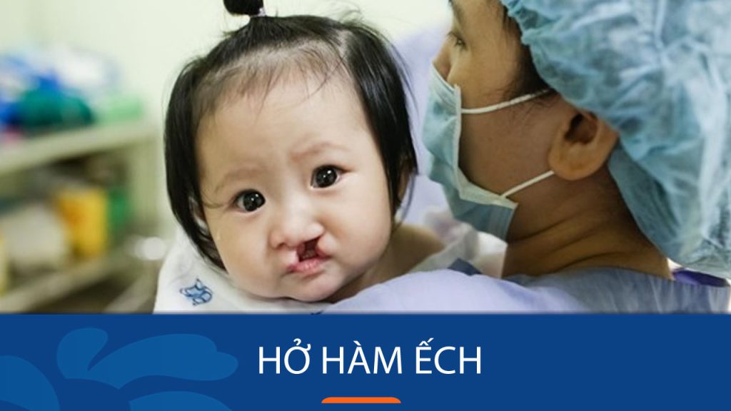 Hở hàm ếch là gì? Nguyên nhân dẫn đến hở hàm ở trẻ nhỏ
