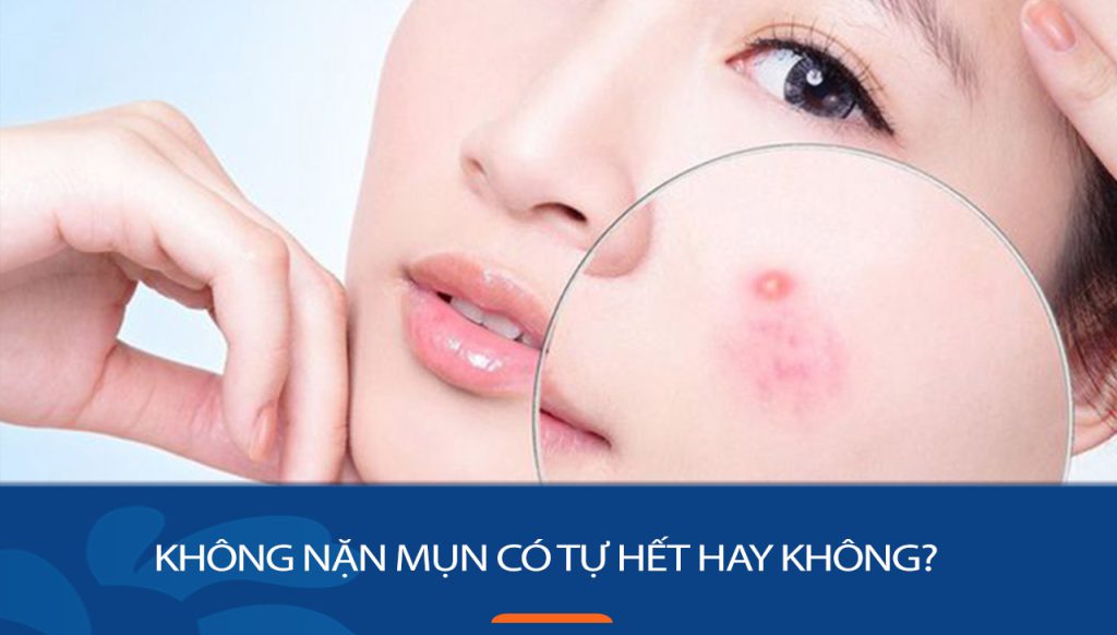 Không nặn mụn có tự hết? Giải đáp thắc mắc và hướng dẫn cách xử lý mụn hiệu quả