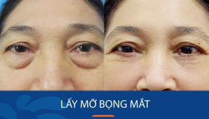 Lấy mỡ bọng mắt – Giải cứu mỡ thừa, trẻ hóa vùng mắt