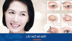 Lấy mỡ mí mắt Hàn Quốc – Nâng tầm vẻ đẹp cho đôi mắt