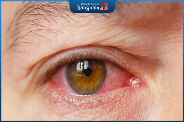 Những căn bệnh về mắt cũng có thể gây ra biến chứng lác