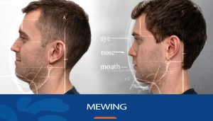Mewing: bài tập chuẩn y khoa và những điều cần biết