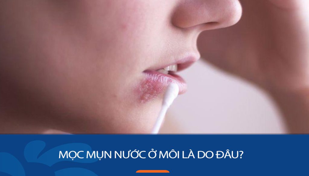 Mụn nước ở môi do herpes: Lây lan và phòng ngừa