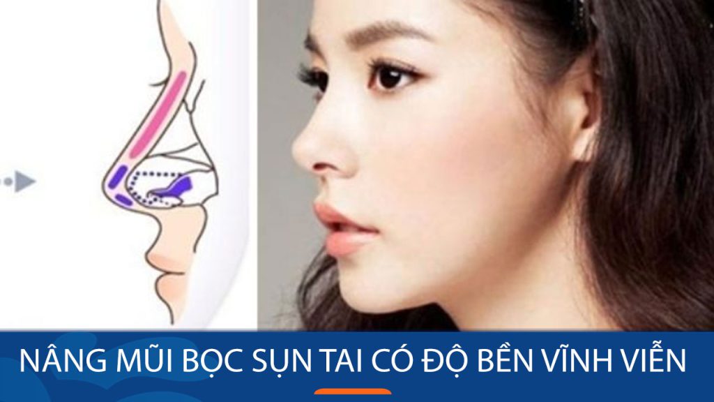 Nâng mũi bọc sụn tai có vĩnh viễn không? BV Kangnam giải đáp