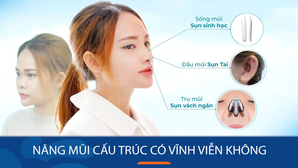 Nâng mũi cấu trúc có vĩnh viễn không?
