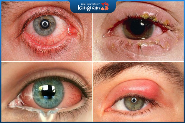 Viêm nhiễm vùng mắt xảy ra khi chăm sóc vệ sinh không kỹ 