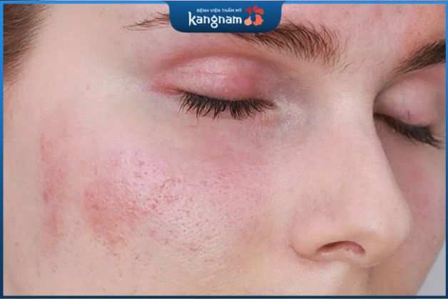 Những nốt mẩn đỏ trên da thường có thể tự giảm dần