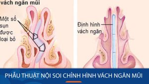 Phẫu thuật nội soi chỉnh hình vách ngăn mũi: Những điều cần biết