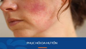 15 Cách Phục hồi da hư tổn sau 3 tháng