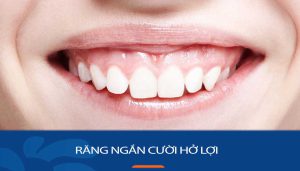 Khắc phục răng ngắn và lợi hở – Cách có nụ cười hoàn hảo