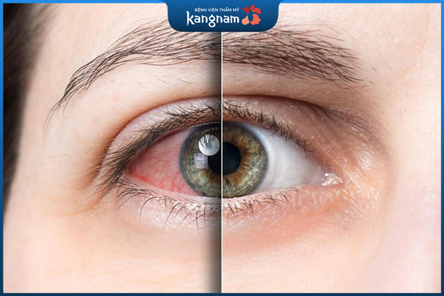 Ở mắt có nhiều dây thần kinh quan trọng chỉ cần sơ suất nhỏ cũng làm mắt bị ảnh hưởng
