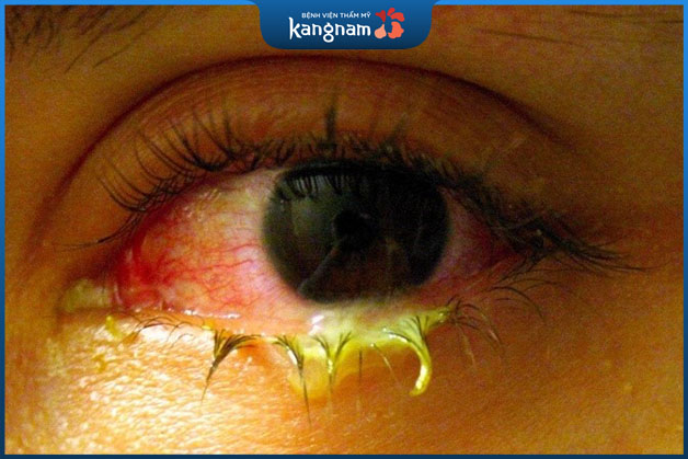 Nhiễm trùng mắt kéo dài không chữa trị cũng khiến mắt mờ đi
