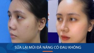 Sửa lại mũi đã nâng có đau không? Giải đáp từ chuyên gia