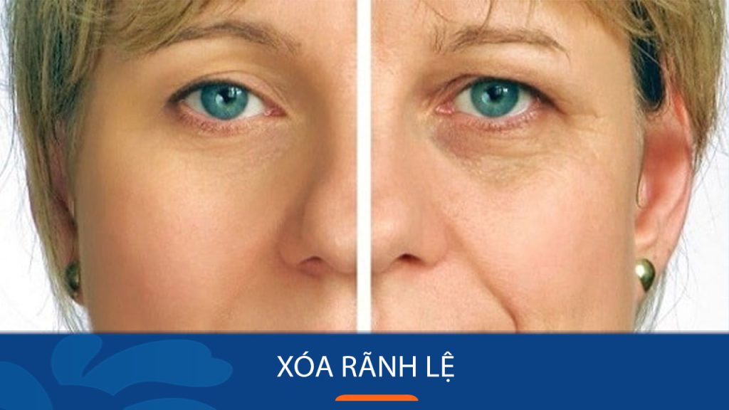 Xóa rãnh lệ vĩnh viễn: Bí quyết lấy lại đôi mắt trẻ trung