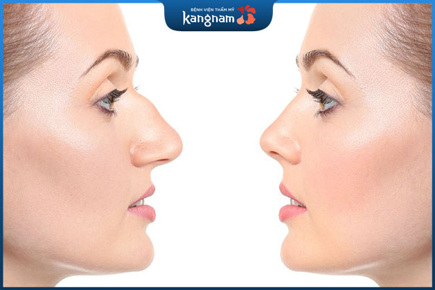 Hình dáng mũi của bố hoặc mẹ cao sẽ di truyền cho con cái 