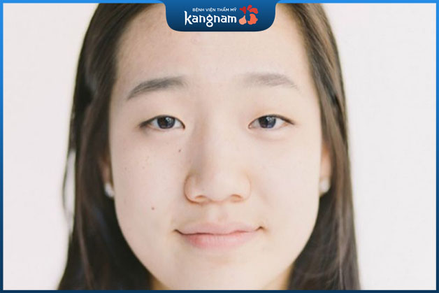 Trong giai đoạn dậy thì cấu trúc xương mũi vẫn đang phát triển nên không nâng mũi 